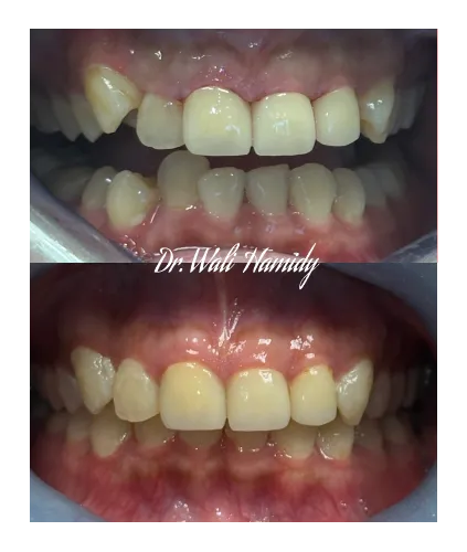invisalign2 gallery