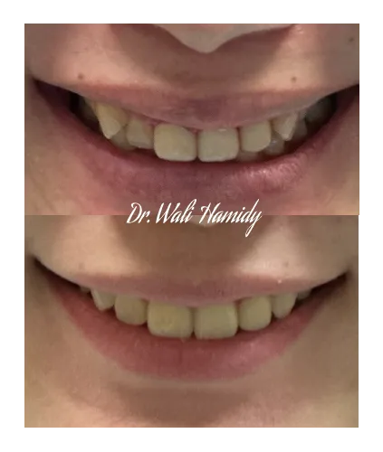 invisalign2 gallery