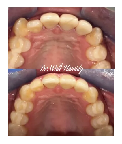 invisalign2 gallery