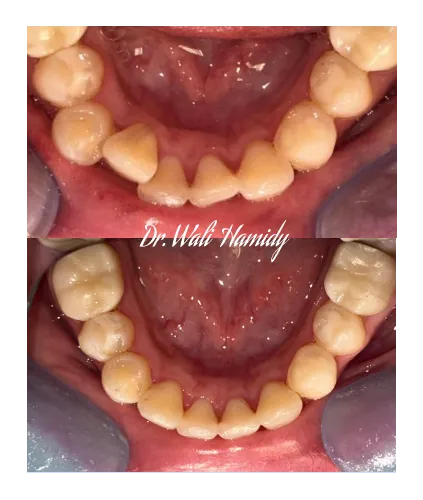 invisalign2 gallery