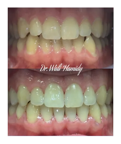invisalign2 gallery