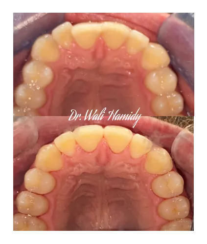 invisalign2 gallery
