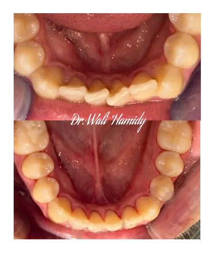 invisalign2 gallery