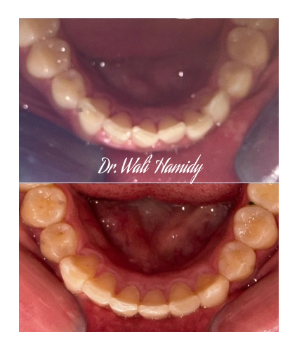 invisalign2 gallery