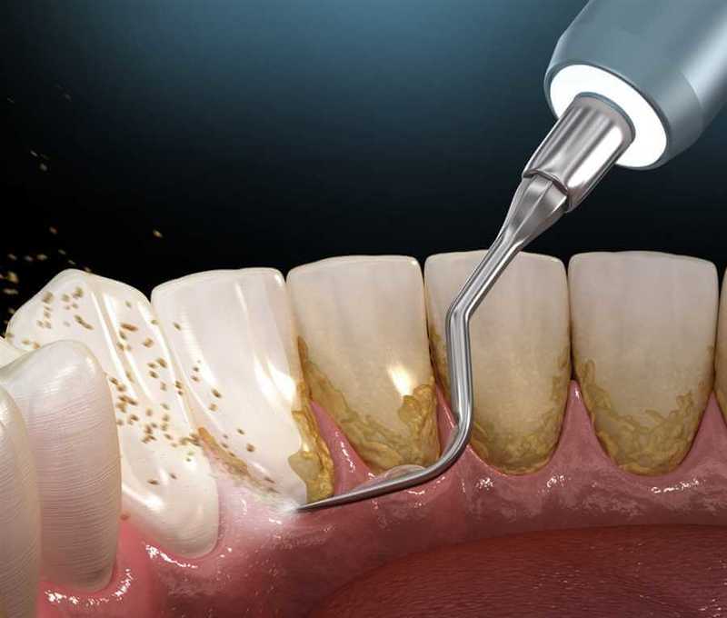 dental plaque